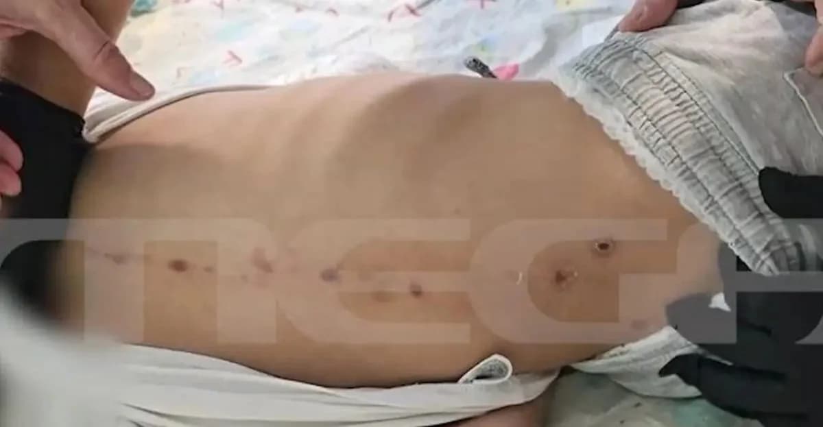 Πάτρα: Έρευνα για κακοποίηση 7χρονου ΑμεΑ – Σημάδια στην πλάτη