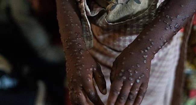 Γκάνα: Πρώτος θάνατος από mpox