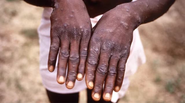 Γκάνα: Πρώτος θάνατος από την επιδημία mpox