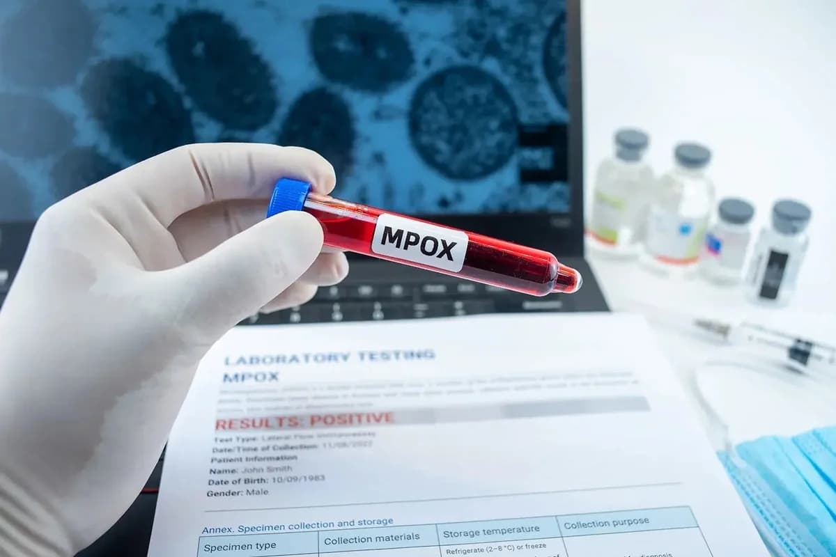Ghana Records First Mpox Death Amid Rising Cases