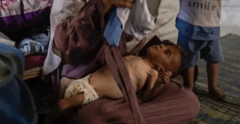 NYT: Niño desnutrido de Gaza tenía otros problemas de salud