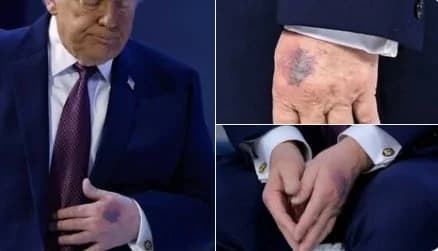 Trump's Hand Bruise Sparks Whispers - His Response